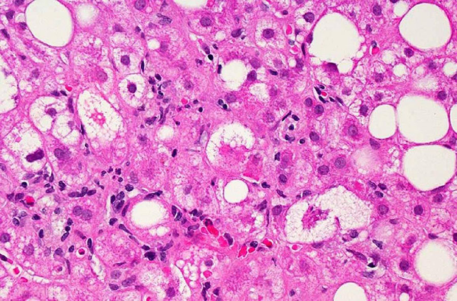 A microscopic image of liver tissue affected by non-alcoholic fatty liver disease (NAFLD)