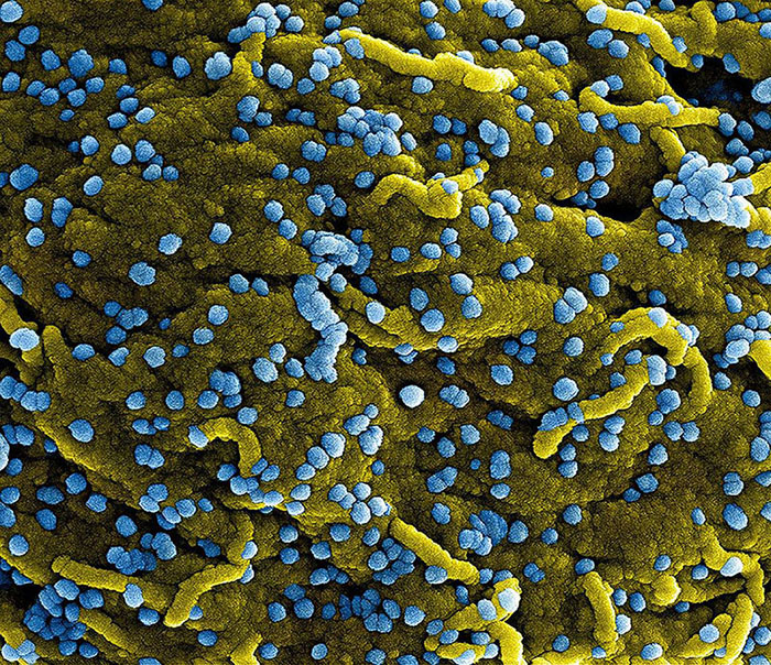 Colorized scanning electron micrograph of Middle East Respiratory Syndrome virus particles attached to the surface of an infected cell.