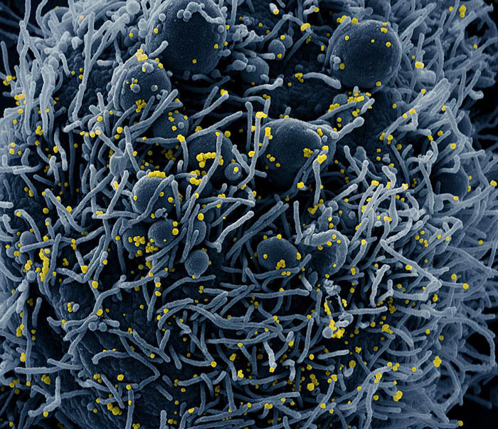 Colorized scanning electron micrograph of an apoptotic cell (blue) infected with SARS-COV-2 virus particles (yellow), isolated from a patient sample