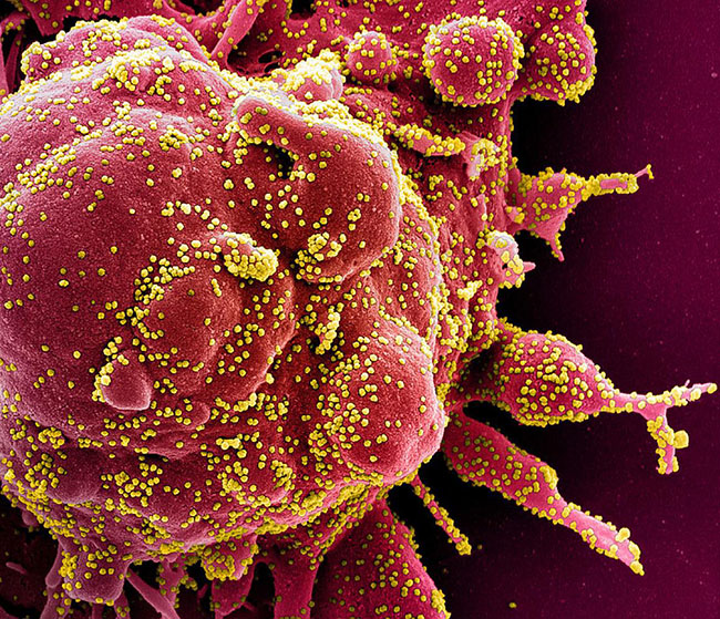 Colorized scanning electron micrograph of an apoptotic cell (red) heavily infected with SARS-COV-2 virus particles (yellow), isolated from a patient sample