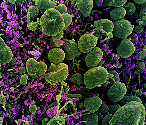Colorized scanning electron micrograph of an apoptotic cell (green) heavily infected with SARS-COV-2 virus particles (purple), isolated from a patient sample.