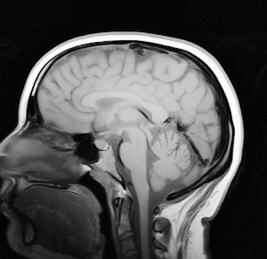 A magnetic resonance image (MRI) of a brain