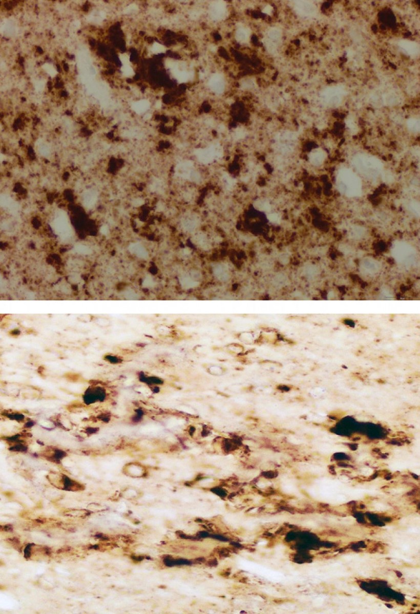 The brain of one patient who died from sporadic Creutzfeldt-Jacob disease (sCJD) appears nearly identical to the brain of a mouse inoculated with infectious prions taken from the skin of patients who died from sCJD.