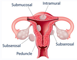 illustration of uterus with fibroids growing in several places
