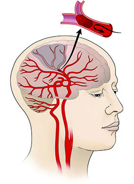 illustration of blood vessels in brain