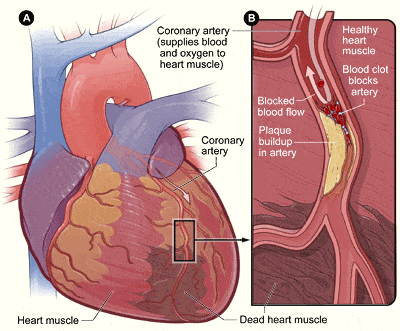 diagram showing plaque buildup in an artery and its effect on the heart