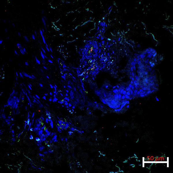 lesional skin biopsy shows co-expression of the endothelial marker CD31 and the activation/adhesion marker, ICAM1, in focal areas of a small vessel in the skin of a patient