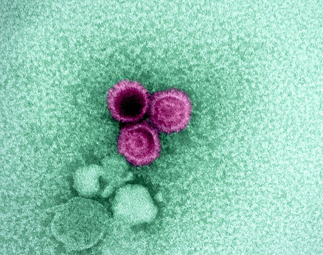 An electron micrograph showing three Epstein-Barr virus (EBV) particles colorized pink