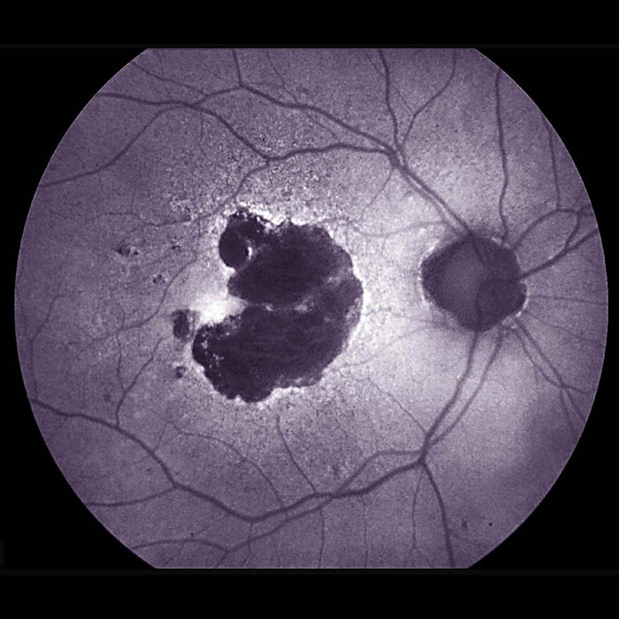 Retina, showing a large region of geographic atrophy