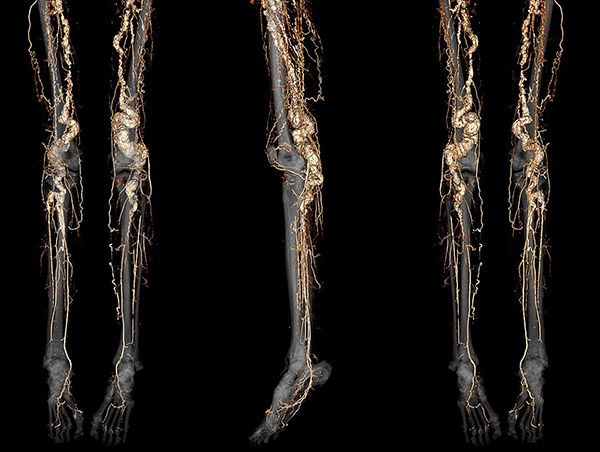 A CT angiography scan of a person with ACDC disease showing abnormal calcification of the blood vessels in the legs and feet.