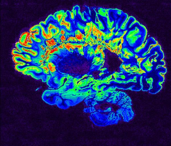 brain scan of a patient with multiple sclerosis