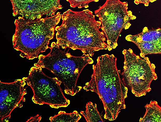 Micrograph of metastatic melanoma cells