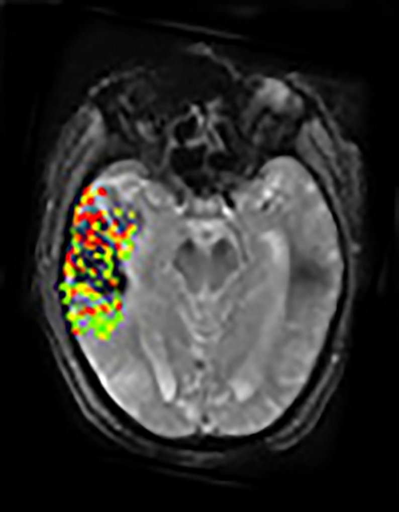 This image combines pre- and post-treatment scans from the same patient. Analysis of the two scans revealed that the area and size of post-treatment bleeding corresponded to blood-brain barrier disruption (shown in green, yellow and red) prior to therapy. Dr. Leigh, NINDS.