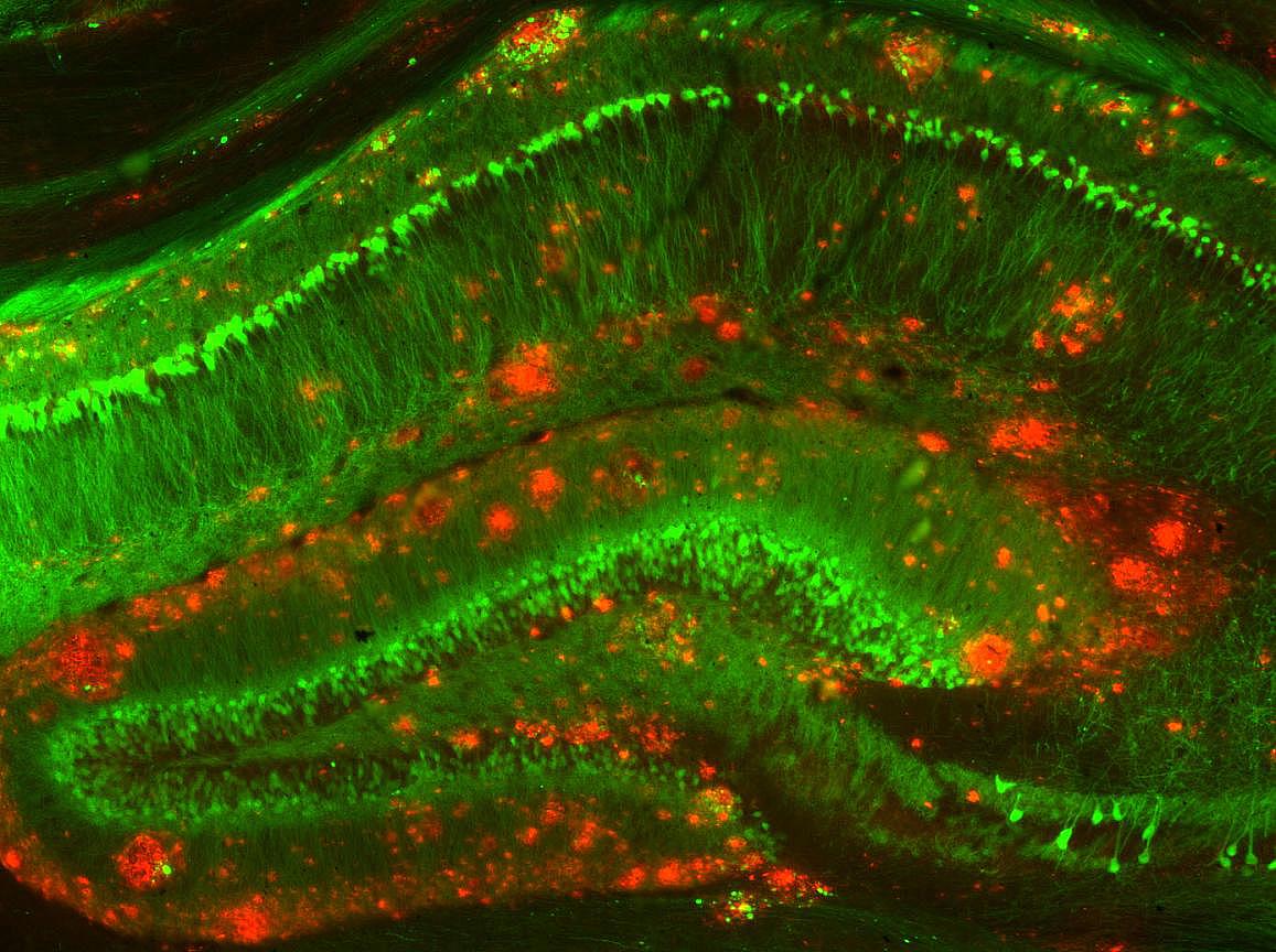 Amyloid beta clusters scattered among neurons in a memory-related area of the brain