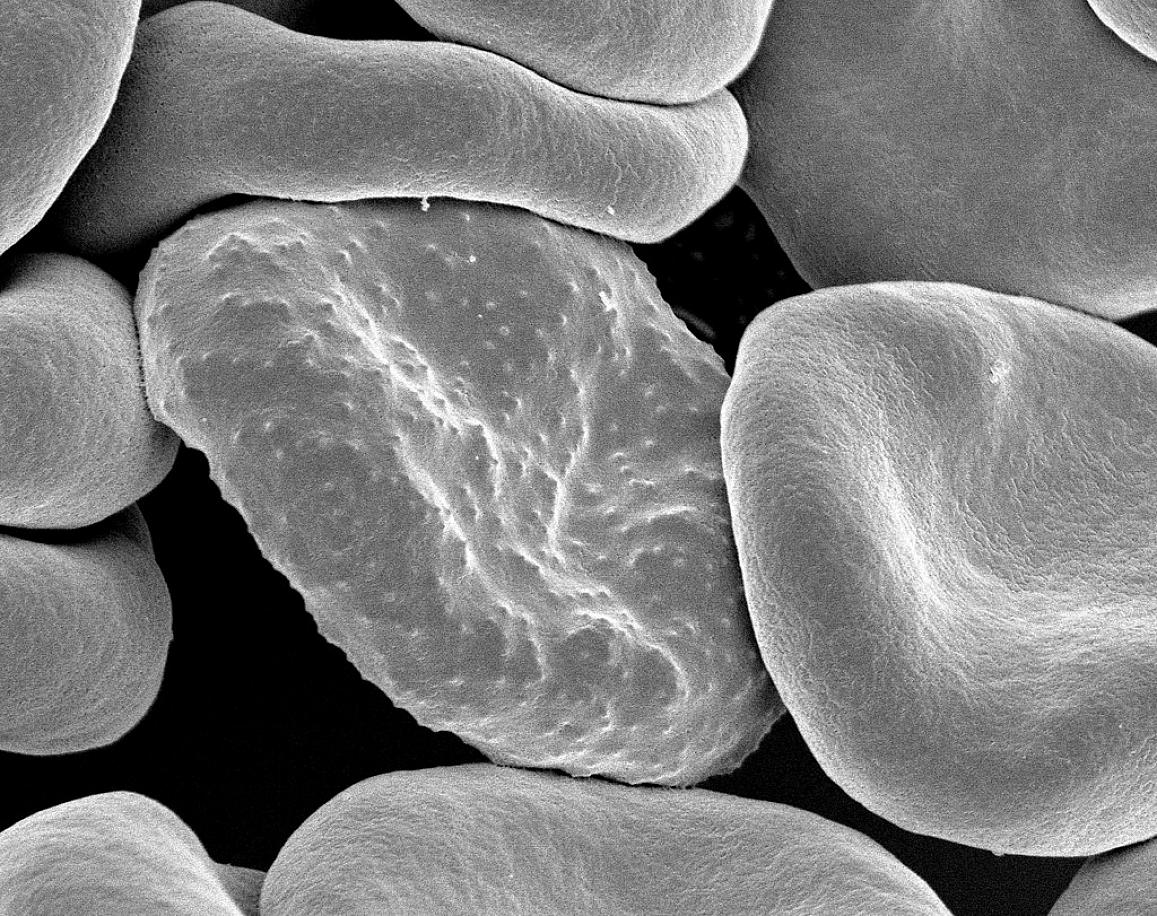 Electron micrograph of red blood cells infected with Plasmodium falciparum, the parasite that causes malaria in humans