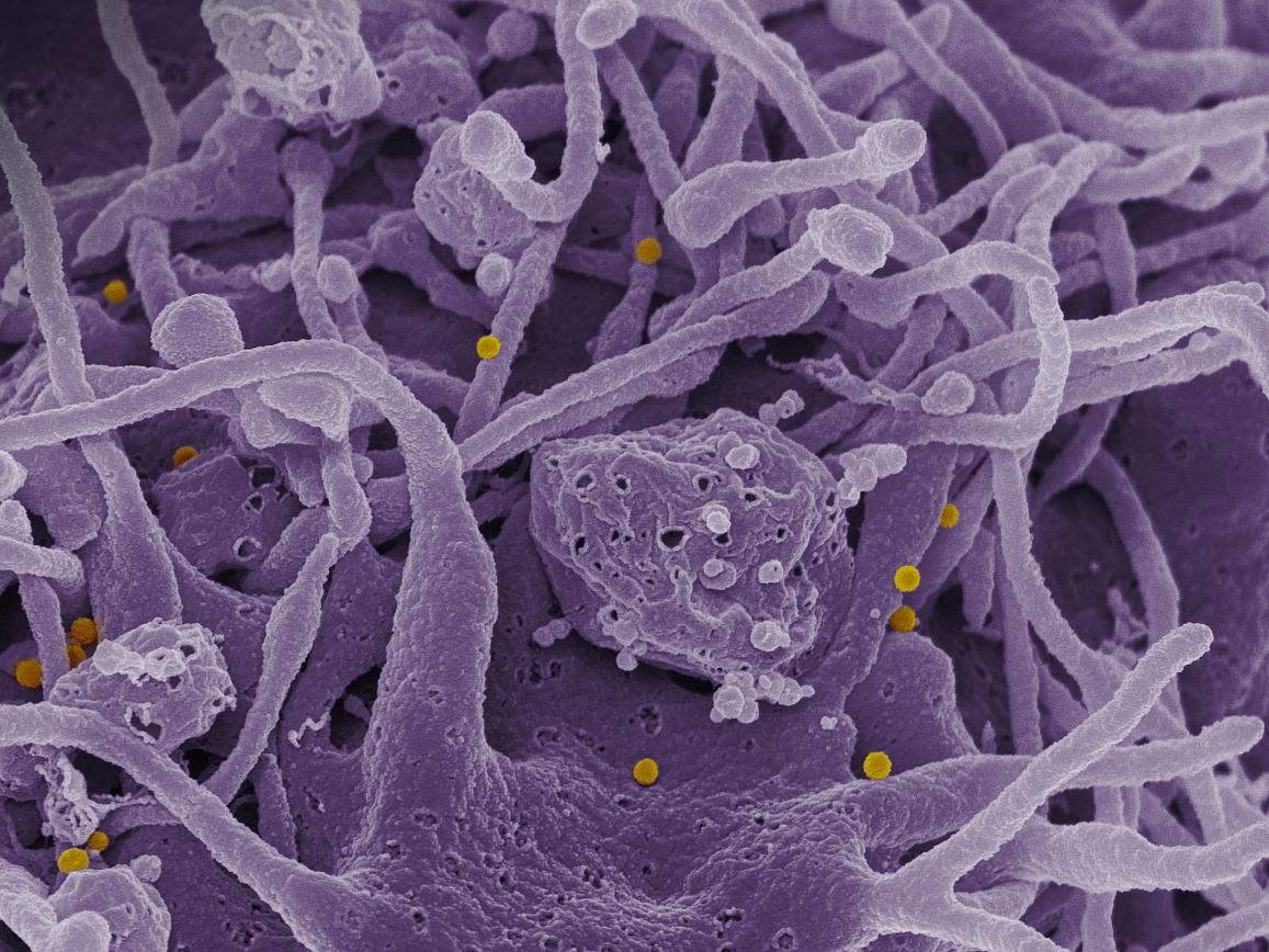 Scanning electron micrograph of CCHF viral particles budding from the surface of cultured epithelial cells from a patient