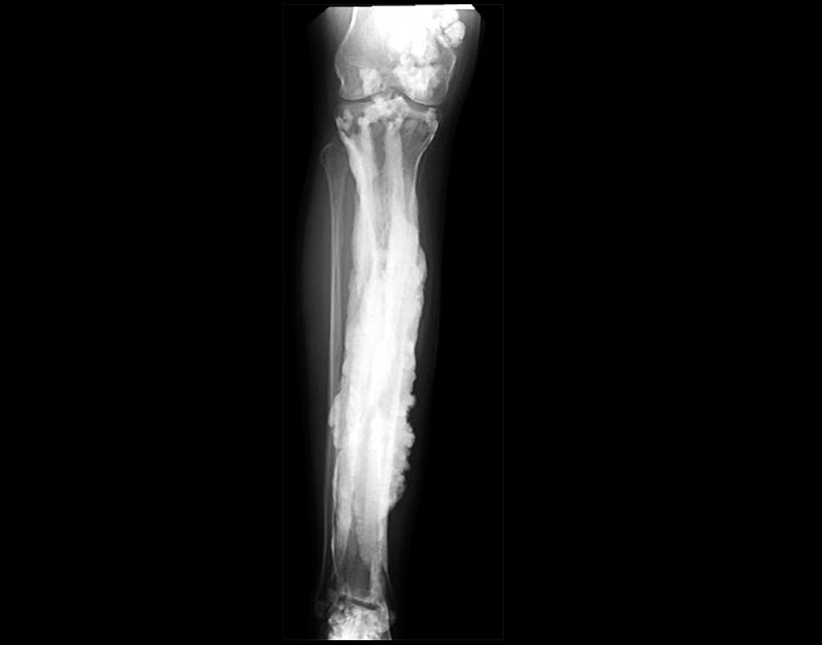 x-ray image of a patient with melorheostosis showing excess bone formation