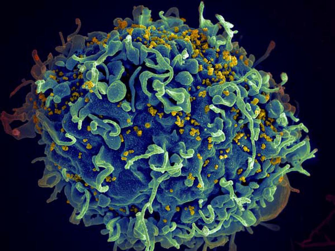 human T cell (blue) under attack by HIV (yellow)