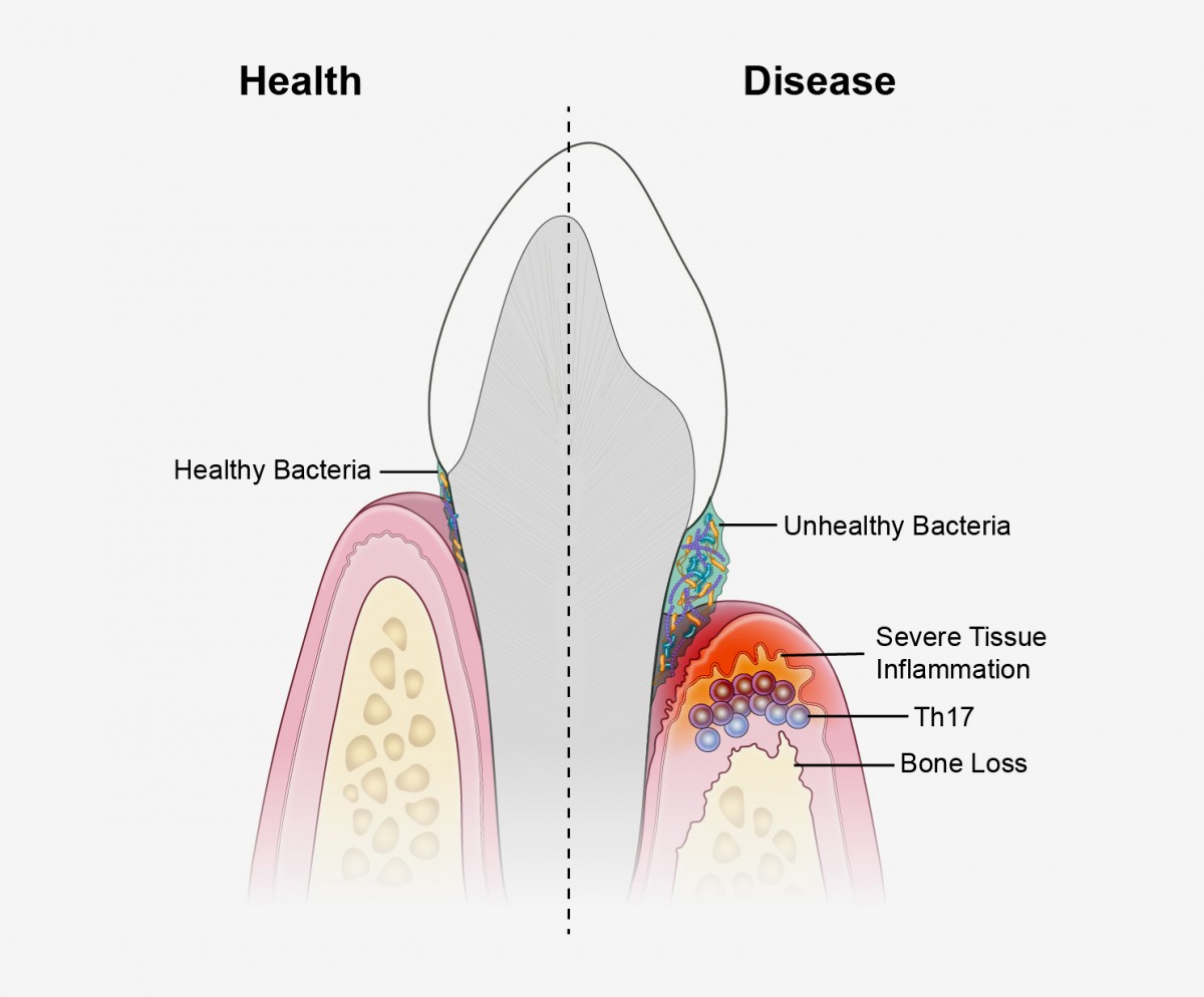 comparison of the effects of healthy and unhealthy bacteria in the mouth