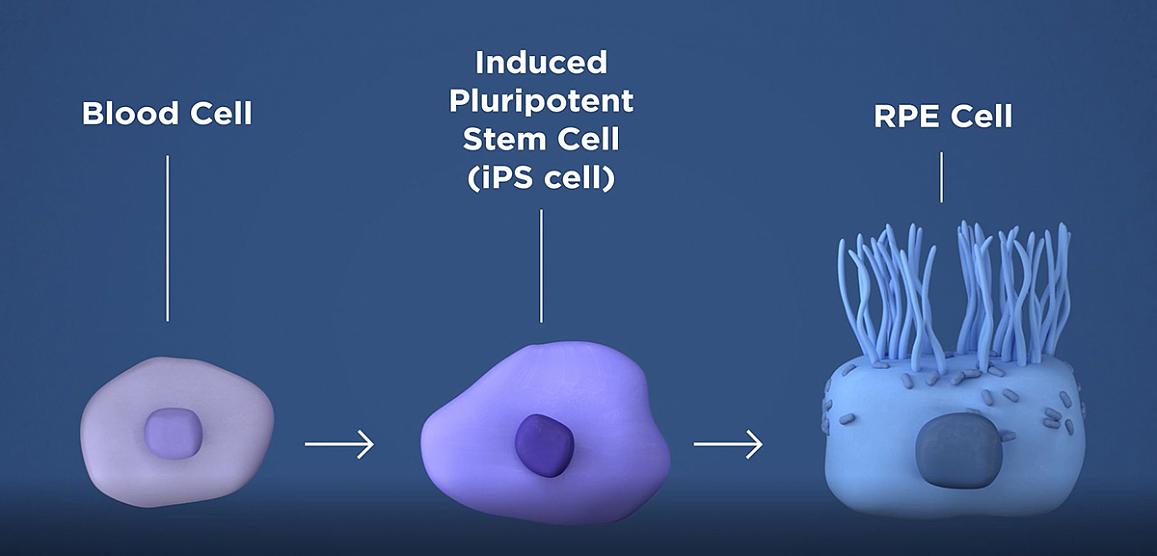 diagram of how patient’s own blood cells can be transformed into retinal pigment epithelial cells