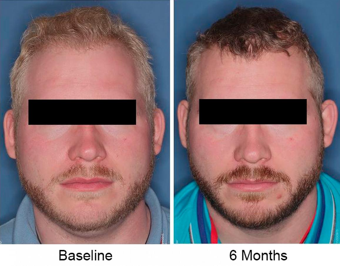 Study participant has darker hair after six months on nitisinone (right), compared to baseline (left)