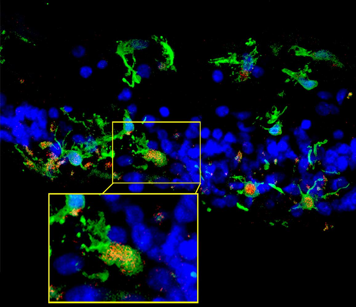 Retinal sections from a patient with retinitis pigmentosa show microglia (green) migrating into the photoreceptor layer (blue) once degeneration had begun