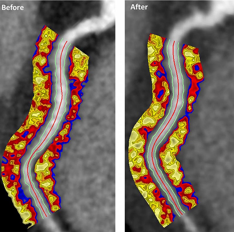 Coronary CT angiography image of the coronary arteries showing changes after psoriasis therapy
