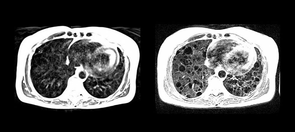 MRI image of lung cysts and surrounding tissues in a patient with lymphangioleiomyomatosis (LAM)