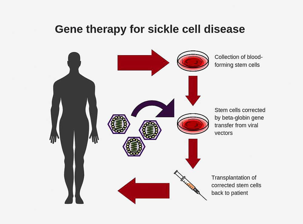Diagram shows steps involved in conducting gene therapy for sickle cell disease
