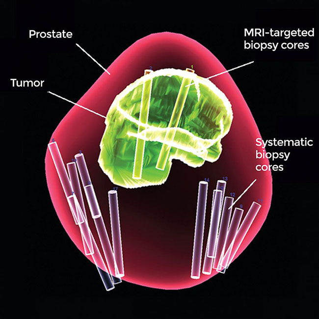 A 3-D map of the prostate using combined MRI-targeted and systematic biopsies.