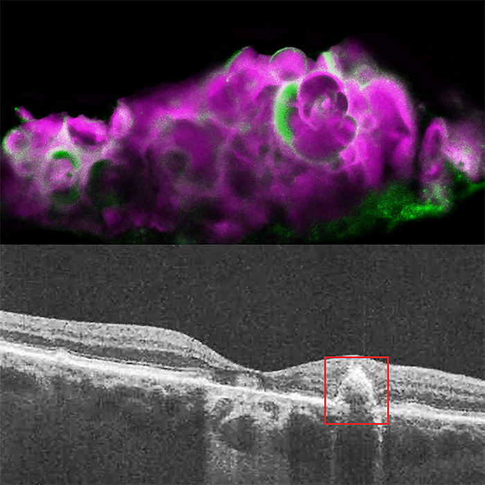 OCT image of eye with dry AMD, showing soft drusen beneath the retinal pigment epithelium.