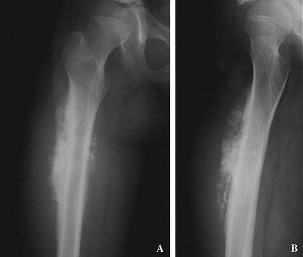 An x-ray of a femur (thigh bone) from a patient with osteosarcoma