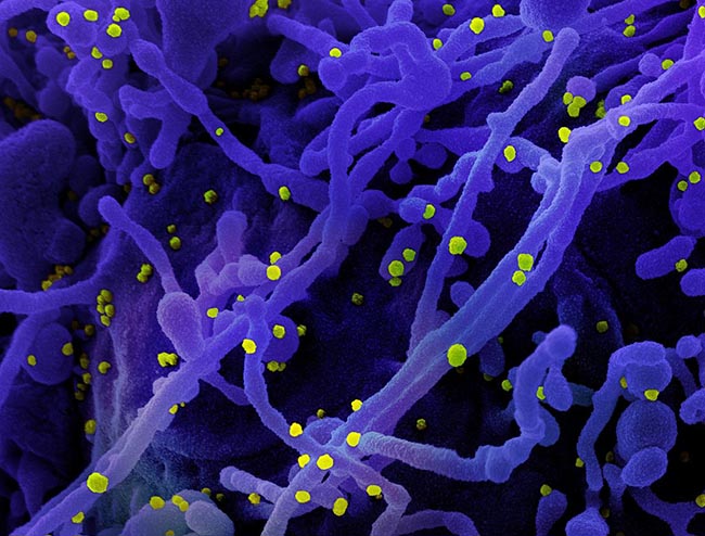 Colorized scanning electron micrograph of a cell (purple) infected with SARS-COV-2 virus particles (yellow), isolated from a patient sample
