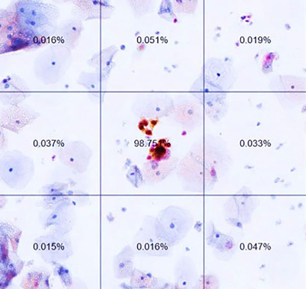 A slide from an automated dual-stain cytology test. The percentages are AI-generated likelihoods of positive results