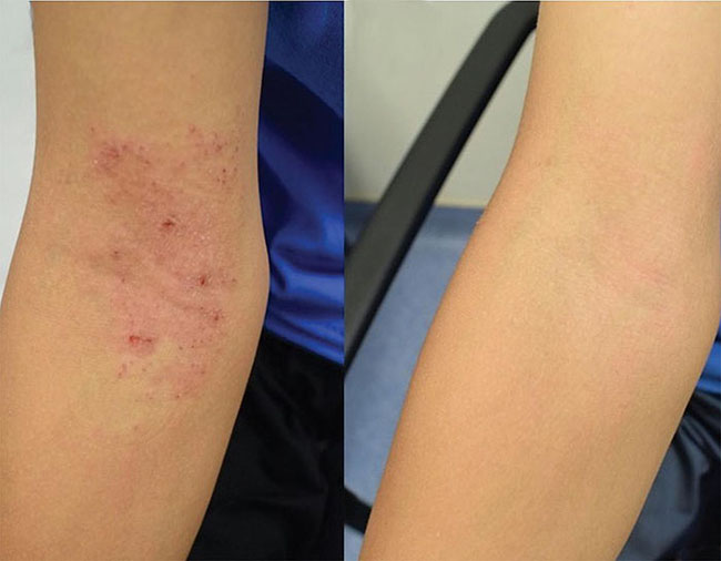 Inner elbow of a child with eczema before Roseomonas mucosa therapy (left) and after four months of treatment (right)