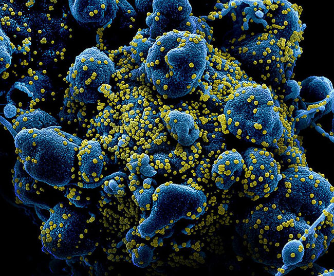 Colorized scanning electron micrograph of an apoptotic cell (blue) heavily infected with SARS-COV-2 virus particles (yellow), isolated from a patient sample