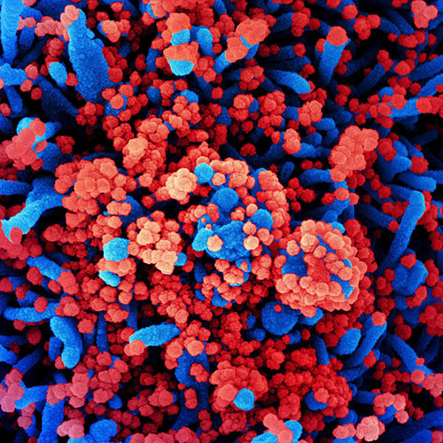 Colorized scanning electron micrograph of a cell (blue) heavily infected with SARS-CoV-2 virus particles (red), isolated from a patient sample