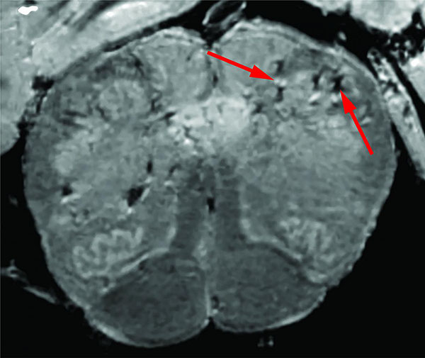 brain image with arrows pointing to light and dark spots that are indicative of blood vessel damage