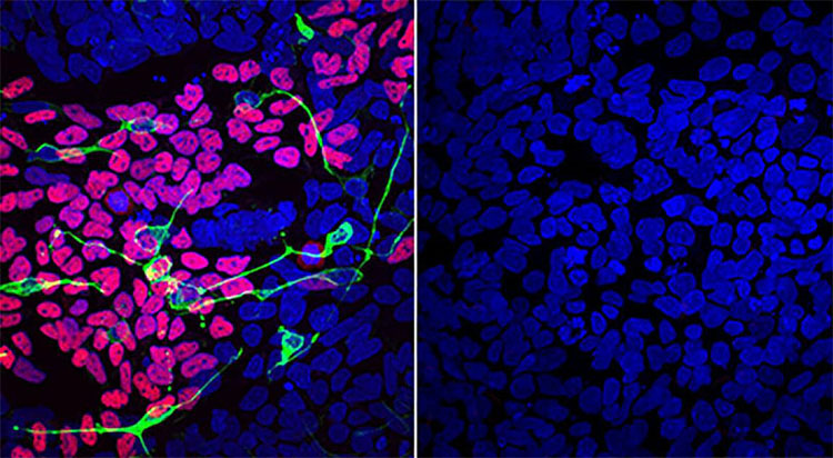 Compared to a disease-free mother (left), differentiated LINKED patient cells (right) lack markers of normal development of the brain, spinal cord and craniofacial skeleton (pink, green and yellow).