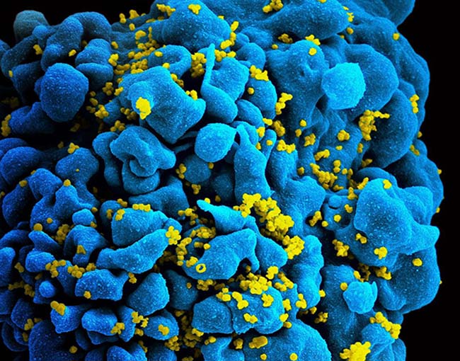 Scanning electromicrograph of an HIV-infected T cell