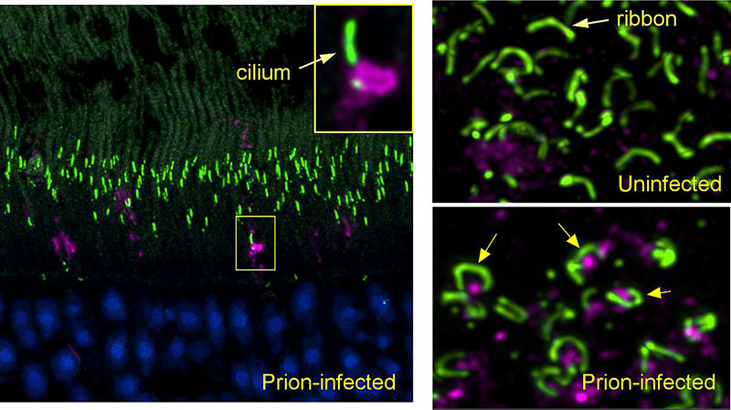 (left panel) Early in prion infection, a prion protein aggregate (magenta) blocks the entrance to a cilium (green) in a retinal photoreceptor. (lower right) In prion-infected retina, prion protein (magenta) accumulates under the horseshoe-shaped ribbon synapses (green) found in photoreceptor terminals.
