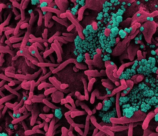 Colorized scanning electron micrograph of a cell (pink) infected with SARS-CoV-2 virus particles (teal)