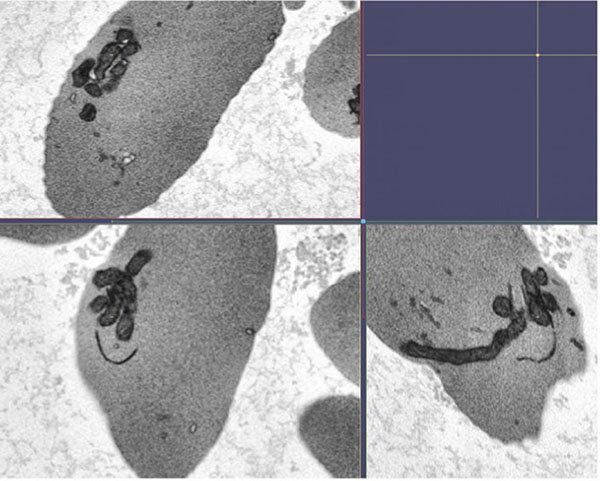 Scanning electron microscopy image of mitochondrial bundles in several sickle cell red blood cells, showing evidence that circulating red blood cells from people with sickle cell disease abnormally retain mitochondria