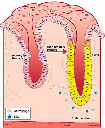 Glucocorticoids and androgens promote a healthy stomach pit by inhibiting inflammation, left, while their absence promotes inflammation and SPEM seen in a diseased pit, right