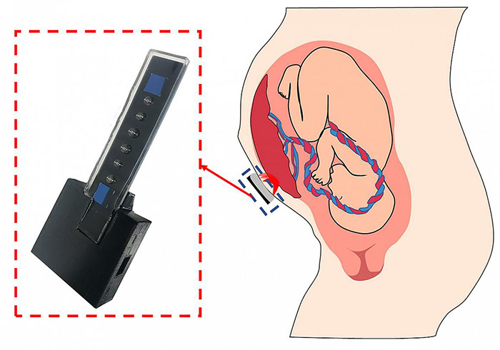 the prototype oxygen sensor next to a diagram of a fetus with forward-facing placenta