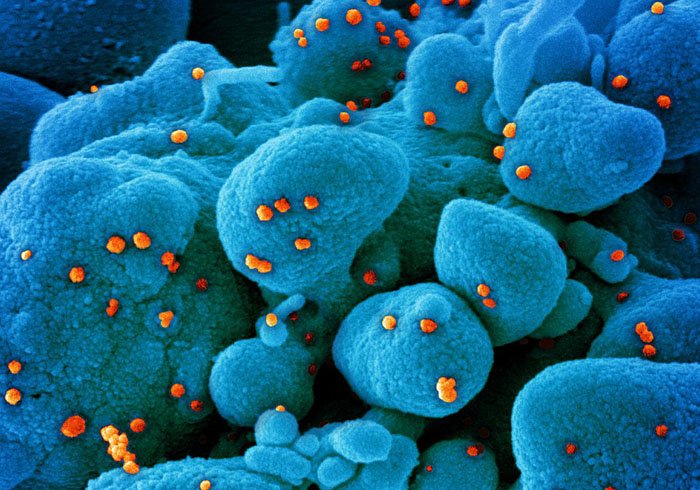 Colorized scanning electron micrograph of an apoptotic cell (blue) infected with SARS-COV-2 virus particles (orange), isolated from a patient sample