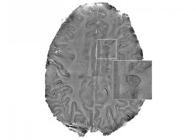 brain map of multiple sclerosis lesions