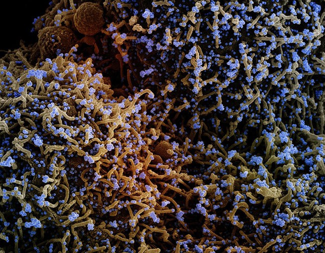 Colorized scanning electron micrograph of a cell infected with a variant strain of SARS-CoV-2 virus particles (blue), isolated from a patient sample