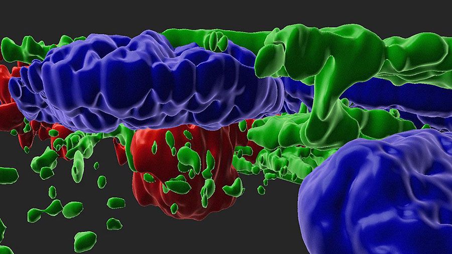 A 3D view of complement activated RPE cells (green - cytoskeleton, blue – nucleus) with drusen/APOE (red) deposits.