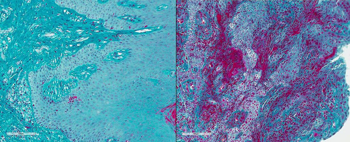 Compared to healthy volunteers (left), gum tissue from people with severe periodontal disease (right) shows high levels of fibrin (magenta).